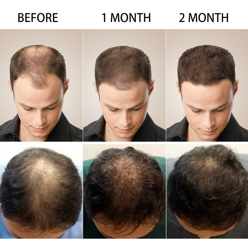 South Moon™ 2023 Biotin Fast Hair Growth Oil Unisex
