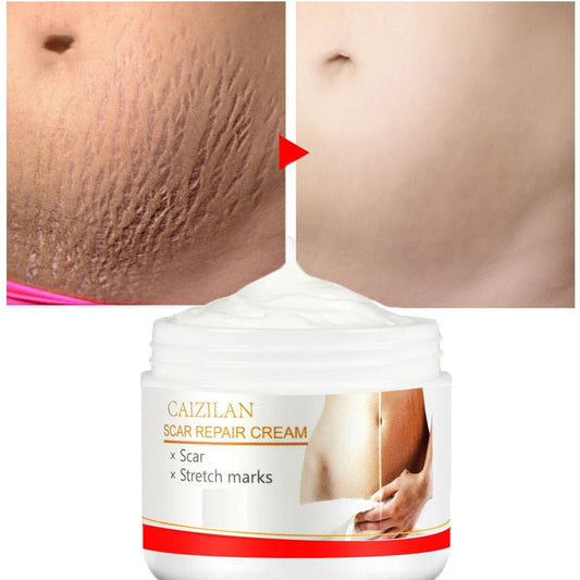 Scar Repair Cream AcnePregnant Stretch Marks Removal Fat Striae Gravidarum 30g