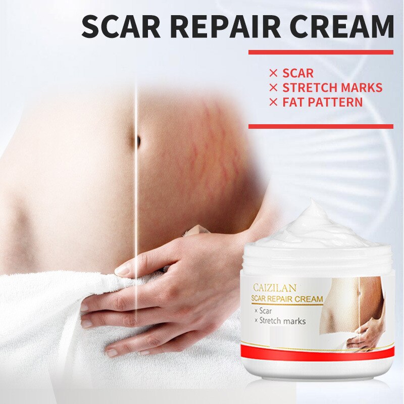 Scar Repair Cream AcnePregnant Stretch Marks Removal Fat Striae Gravidarum 30g