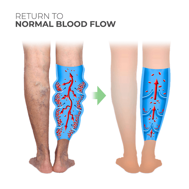 Wormwood Varicose Veins Care Soap