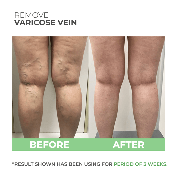 Wormwood Varicose Veins Care Soap