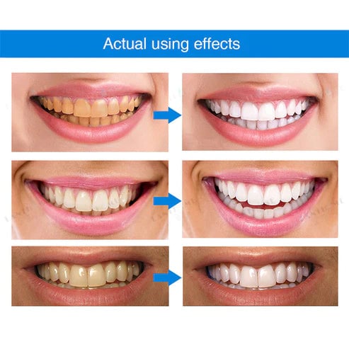 🔥Last Day Promotion 50% OFF🔥-Teeth Whitening Essence
