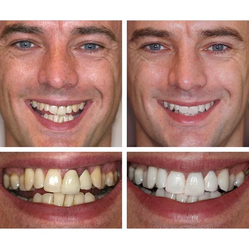 🔥Last Day Promotion 50% OFF🔥-Teeth Whitening Essence