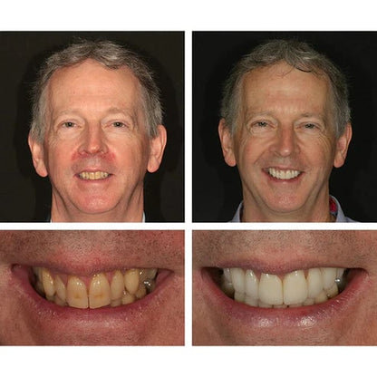 🔥Last Day Promotion 50% OFF🔥-Teeth Whitening Essence