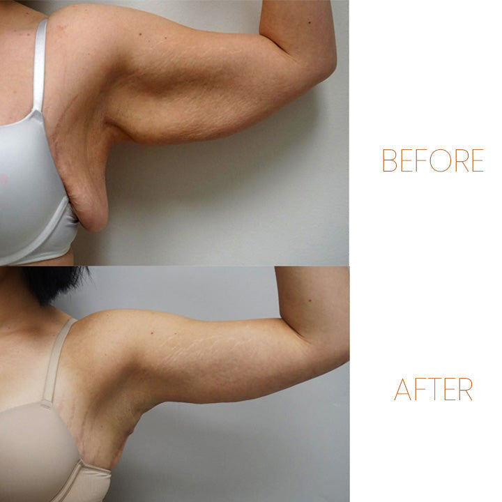 Magnetic Lymphatic Drainage Therapeutic Ring