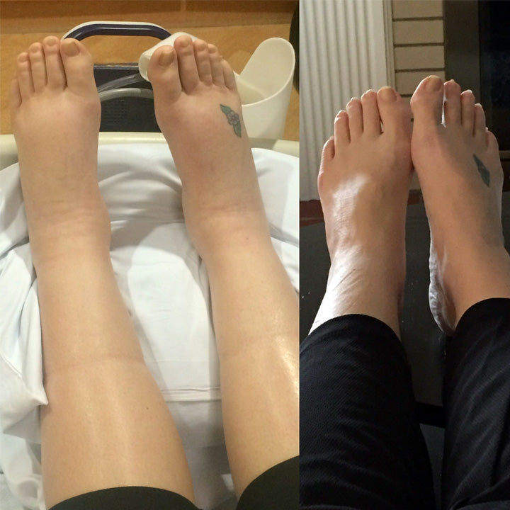 Lymphedema Therapy Detox Foot Pads