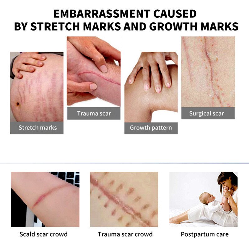 Scar Repair Cream AcnePregnant Stretch Marks Removal Fat Striae Gravidarum 30g
