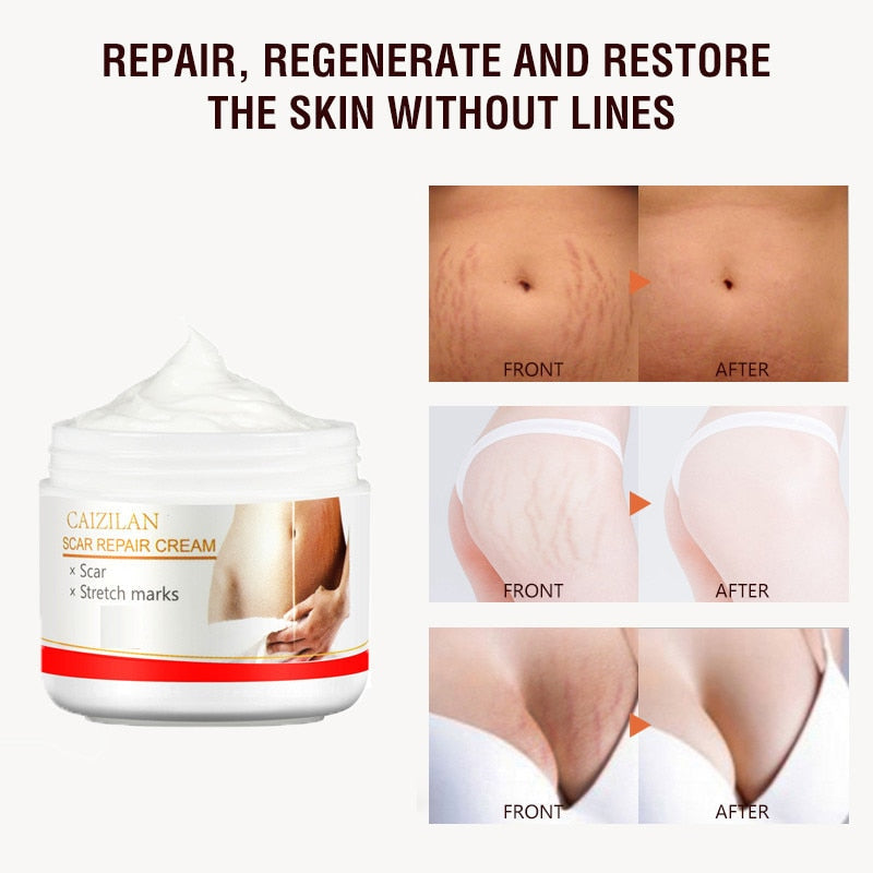 Scar Repair Cream AcnePregnant Stretch Marks Removal Fat Striae Gravidarum 30g