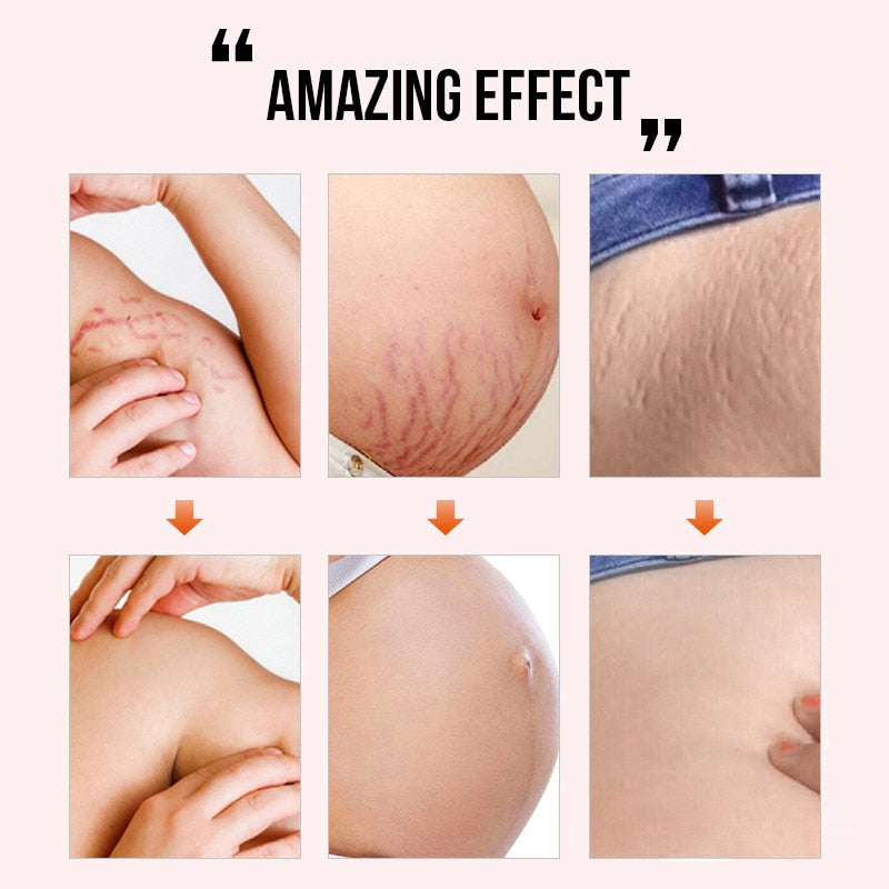 Scar Repair Cream AcnePregnant Stretch Marks Removal Fat Striae Gravidarum 30g