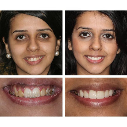 🔥Last Day Promotion 50% OFF🔥-Teeth Whitening Essence