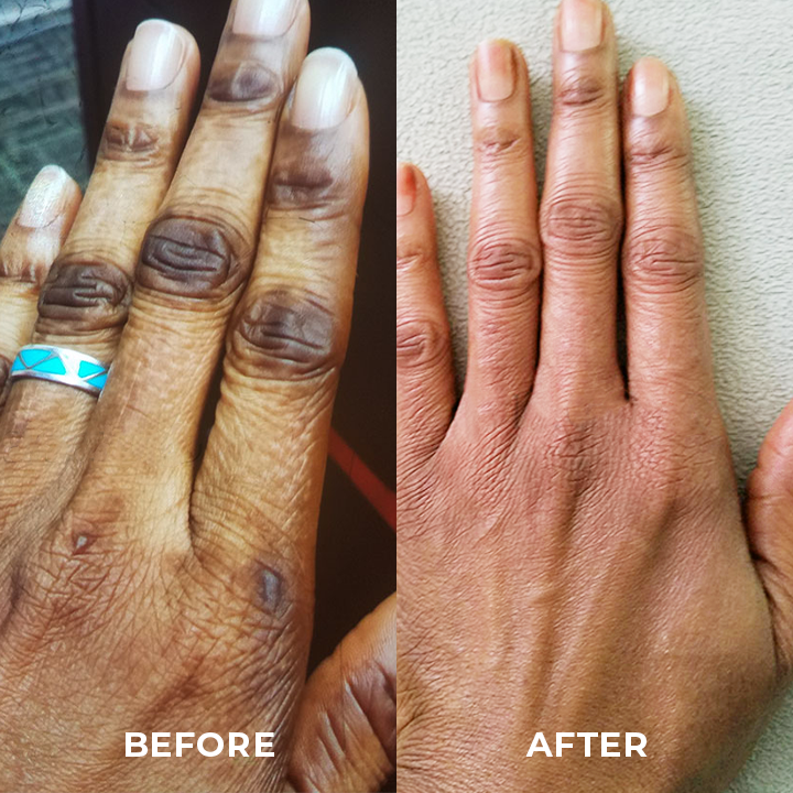 BioLap™ Dark Spot Correcting Cream